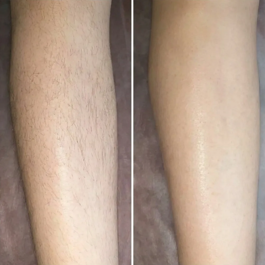 Antes e depois de depilação a laser – resultado 1