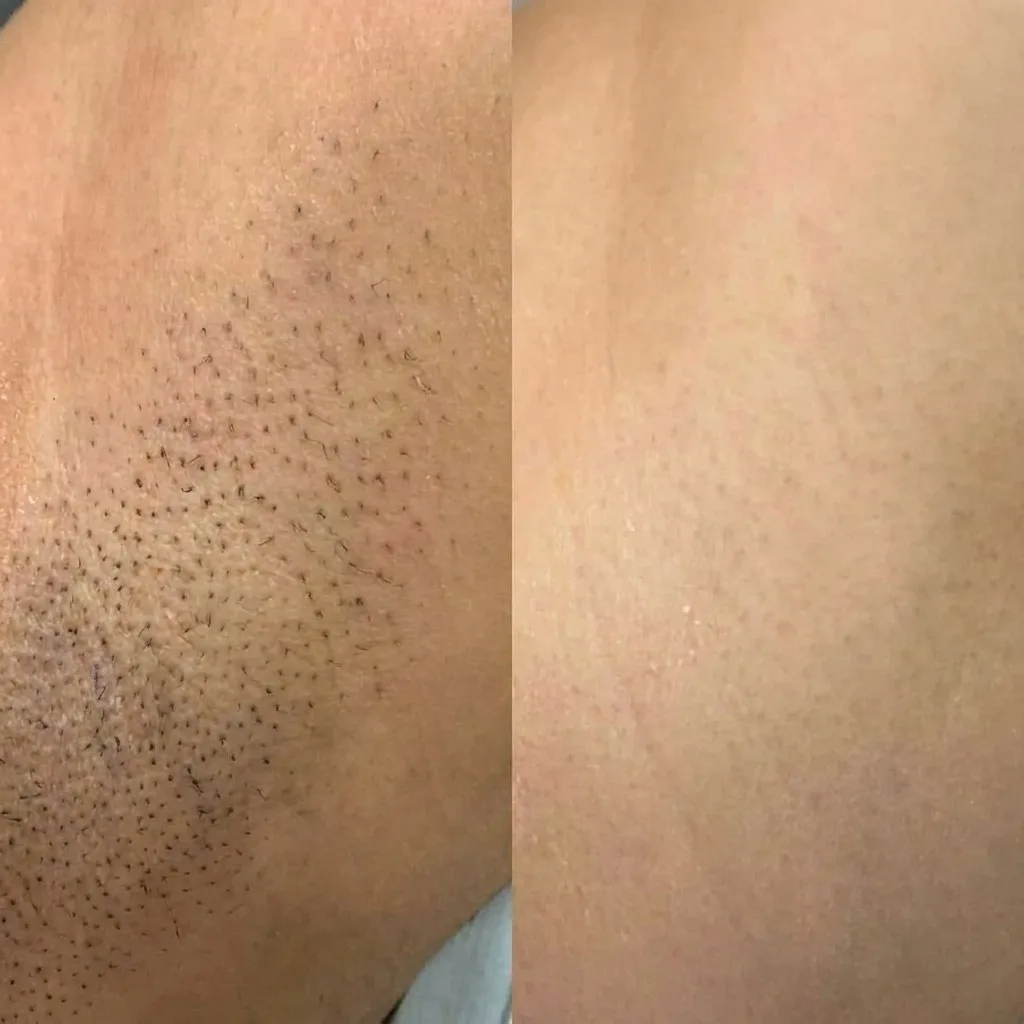 Antes e depois de depilação a laser – resultado 2