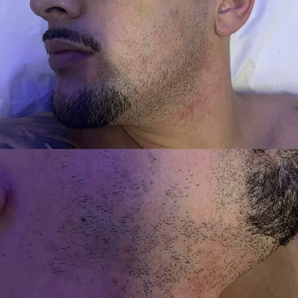 Antes e depois de depilação a laser – resultado 3