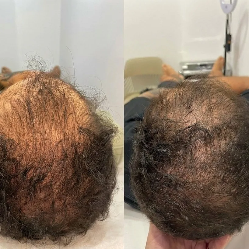 Antes e depois de terapia capilar